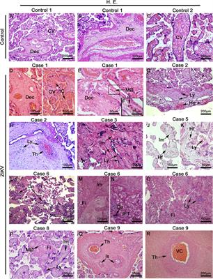 Zika Induces Human Placental Damage and Inflammation